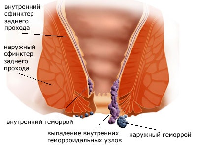 Безоперационное лечение геморроя в курске