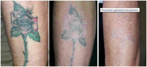 lazer_udal_tatu_02 lazer_udal_tatu_02