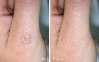 udalenie_borodavok_azotom_02 udalenie_borodavok_azotom_02