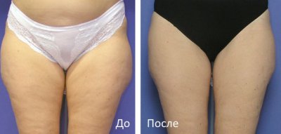 mezodissolyciya_03 mezodissolyciya_03