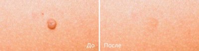 udalenie_rodinok_laserom_02 udalenie_rodinok_laserom_02