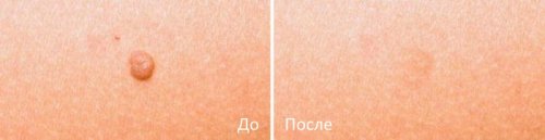 udalenie_rodinok_laserom_02 udalenie_rodinok_laserom_02