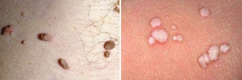 papilloma1 papilloma1