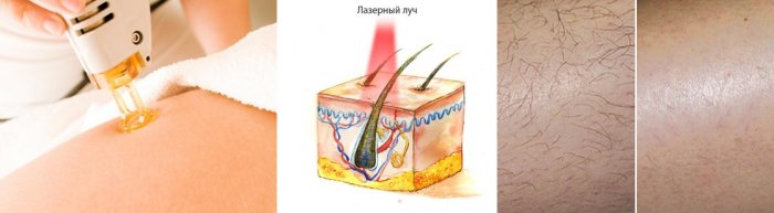 chto_luchshe_laser_electro02 chto_luchshe_laser_electro02