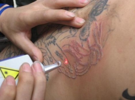 lazer_udal_tatu_03 lazer_udal_tatu_03