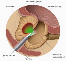 lechenie_adenomy_05 lechenie_adenomy_05