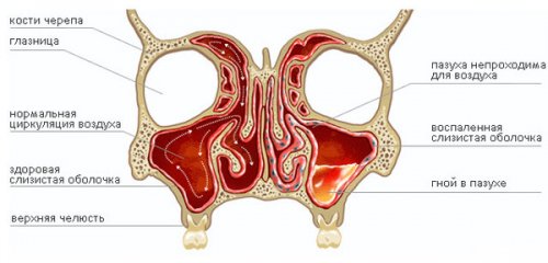lechenie_gaimorita_03 lechenie_gaimorita_03