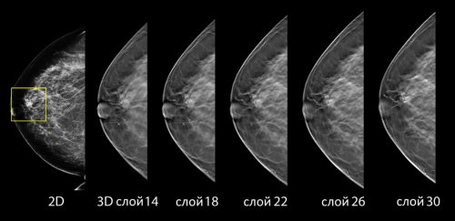 3d-mammograma-2 3d-mammograma-2