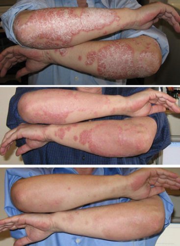 xtrac-laser-psoriaz xtrac-laser-psoriaz