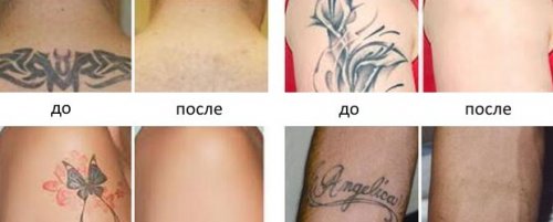 udalenie-tatu-do-posle2 udalenie-tatu-do-posle2