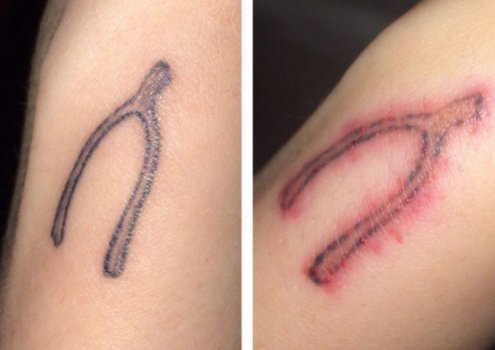udalenie-tatu-do-posle-3 udalenie-tatu-do-posle-3