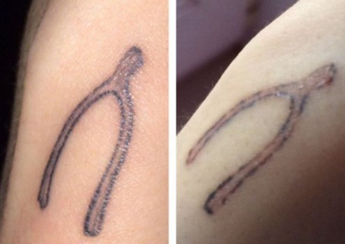 udalenie-tatu-do-posle-4 udalenie-tatu-do-posle-4