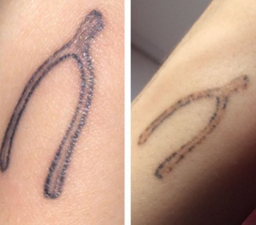 udalenie-tatu-do-posle-5 udalenie-tatu-do-posle-5