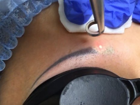 udalenie-tatuazha-brovej-2 udalenie-tatuazha-brovej-2