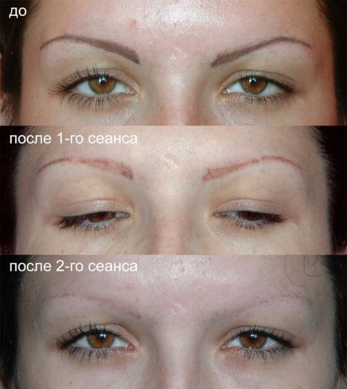 udalenie-tatuazha-brovej-3 udalenie-tatuazha-brovej-3