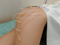 Озонотерапия, области применения