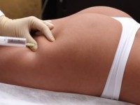 Мезодиссолюция - удаление жировых отложений