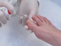 Эффективное лечение грибка ногтей