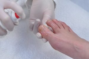 Эффективное лечение грибка ногтей