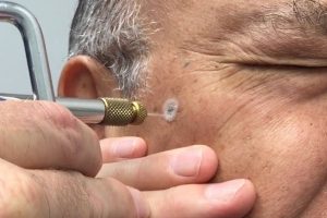 Криохирургия против рака: задачи, процедура и возможные осложнения