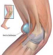 Киста бейкера коленного сустава лечение лазером thumbnail