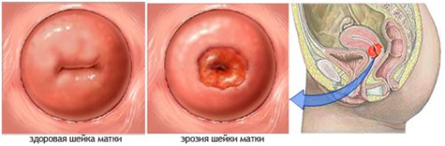 radiovolnovoe_lechenie_erozii_01 radiovolnovoe_lechenie_erozii_01