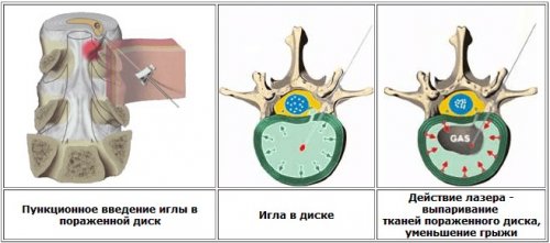 gryzha_pozvonochn_04 gryzha_pozvonochn_04