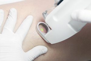 Удаление сосудистых звездочек