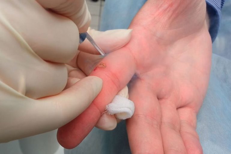 Удаление бородавки лазером