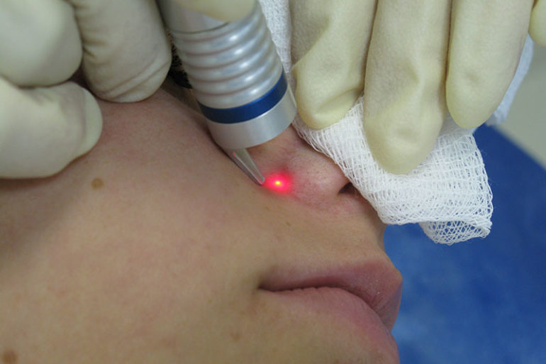 Лазерная коагуляция сосудов