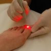Удаление и лечение вросшего ногтя лазером