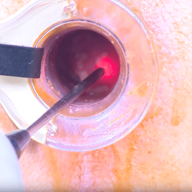 Лечение геморроя лазером