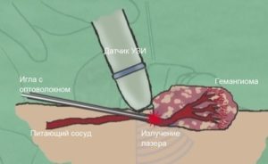 Применение лазера при лечении гемангиомы