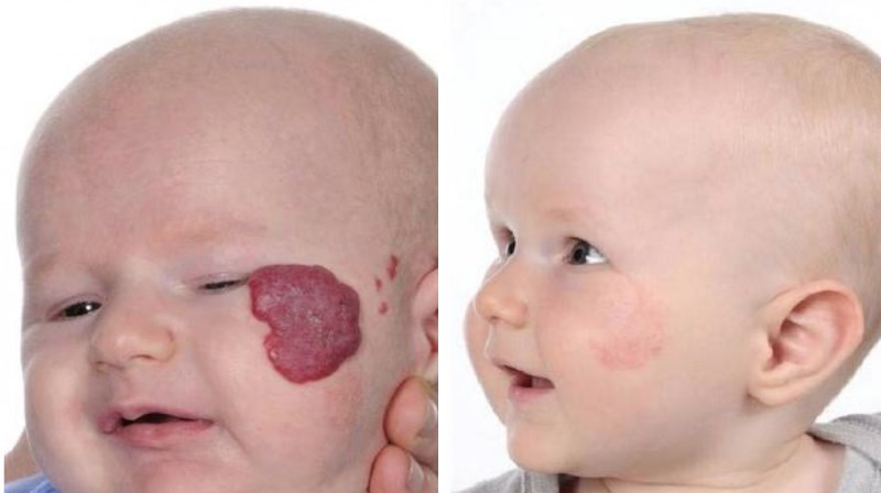 Фото до и после удаление гемангиомы у ребенка лазером