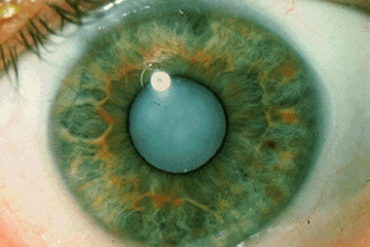 Лечение катаракты лазером