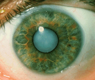 Лечение катаракты лазером
