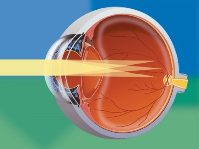 Лазерная коррекция астигматизма