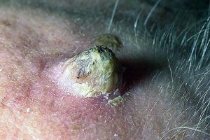 Кожный рог, современный метод удаления лазером