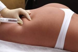 Мезодиссолюция - удаление жировых отложений