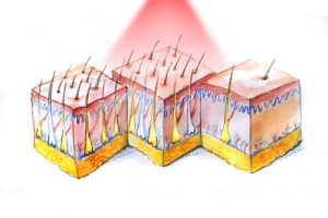 Что лучше лазерная эпиляция или фотоэпиляция?