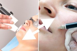 Что лучше лазерная эпиляция или электроэпиляция