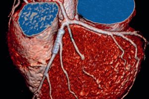 Что лучше для исследования артерий сердца - КТ или МРТ?