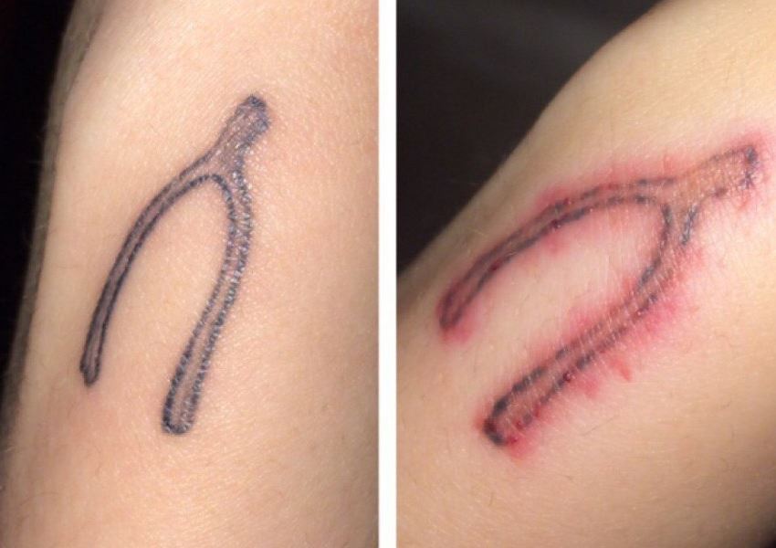 Фото до и после 1-ой процедуры применения лазера на тату