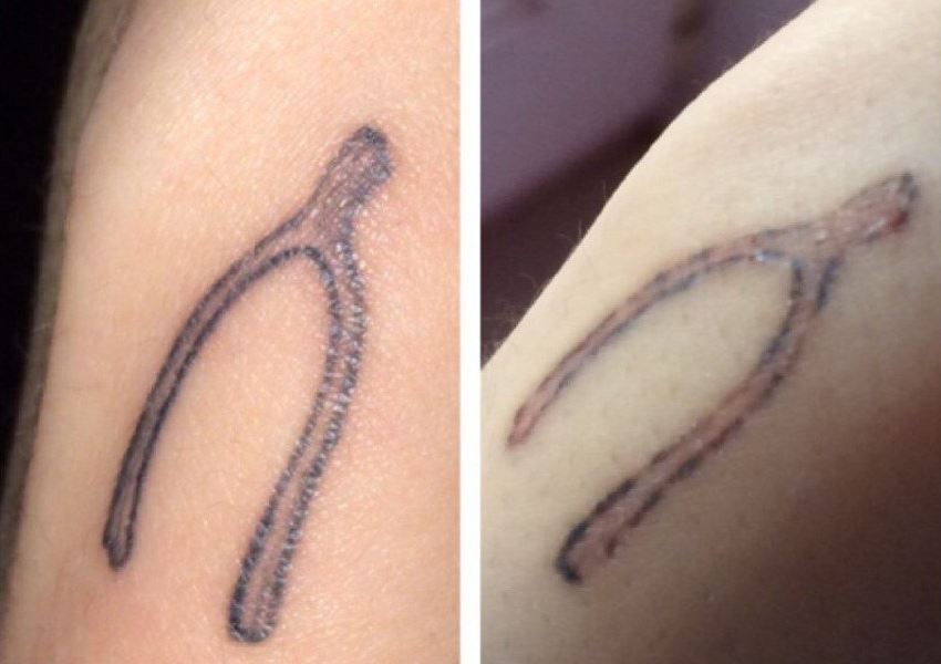 Фото до и спустя 1,5 недели после 1-ой процедуры удаления лазером