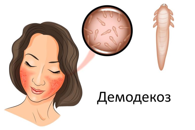 Лечение демодекоза лазером