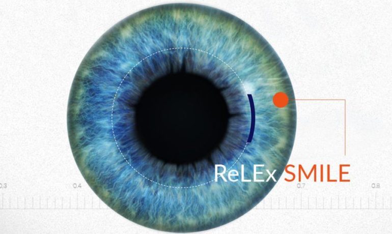 ReLEx SMILE лазерная коррекция зрения