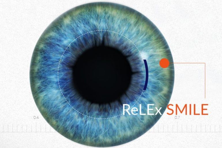 ReLEx SMILE лазерная коррекция зрения