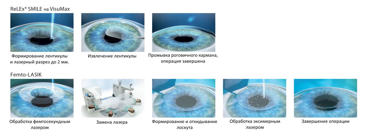 Relex smile clinicaspectr ru. Лазерная коррекция зрения Фемто ласик. Лазерная операция ФЕМТОЛАСИК. Лазерная коррекция методом Фемто ласик.