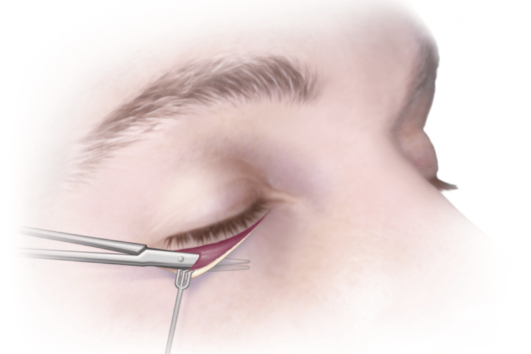 Что такое блефаропластика