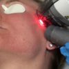 Фраксель лазерная терапия кожи лица